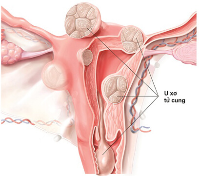 Phương pháp chữa trị bệnh u xơ cổ tử cung